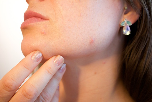 a woman with pimples on her face.